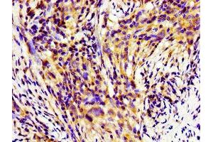 Immunohistochemistry of paraffin-embedded human pancreatic cancer using ABIN7155253 at dilution of 1:100 (HINT1 抗体  (AA 2-126))
