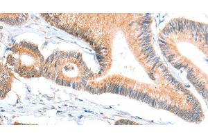 Immunohistochemistry of paraffin-embedded Human colon cancer tissue using ACSBG1 Polyclonal Antibody at dilution 1:40 (ACSBG1 抗体)