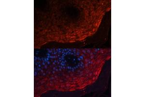 Immunofluorescence analysis of human skin cancer using S100 Polyclonal Antibody (ABIN3022395, ABIN3022396, ABIN3022397 and ABIN6218783) at dilution of 1:100 (40x lens). (S100A8 抗体  (AA 1-93))