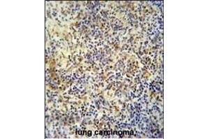 KRI1 antibody (N-term) (ABIN654199 and ABIN2844048) immunohistochemistry analysis in formalin fixed and paraffin embedded human lung carcinoma followed by peroxidase conjugation of the secondary antibody and DAB staining. (KRI1 抗体  (N-Term))