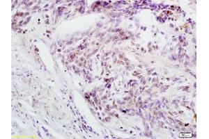 Formalin-fixed and paraffin embedded human rectal carcinoma labeled with Anti-Phospho-cdc25C (Thr48) Polyclonal Antibody, Unconjugated  at 1:200 followed by conjugation to the secondary antibody and DAB (CDC25C 抗体  (pThr48))