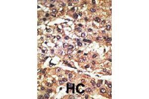 Formalin-fixed and paraffin-embedded human hepatocellular carcinoma tissue reacted with GPR37 polyclonal antibody  , which was peroxidase-conjugated to the secondary antibody, followed by DAB staining . (GPR37 抗体  (N-Term))