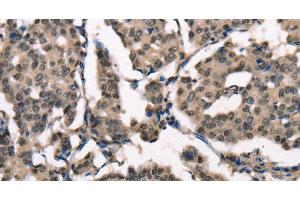 Immunohistochemistry of paraffin-embedded Human breast cancer using NSMCE3 Polyclonal Antibody at dilution of 1:40 (Necdin-Like 2 抗体)