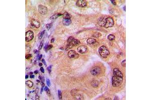 Immunohistochemical analysis of NF-kappaB p105 staining in human breast cancer formalin fixed paraffin embedded tissue section. (NFKB1 抗体  (C-Term))