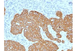 Formalin-fixed, paraffin-embedded human Basal Cell Carcinoma stained with Cytokeratin 5 (KRT5) Mouse Monoclonal Antibody (KRT5/2080). (Cytokeratin 5 抗体  (AA 318-491))