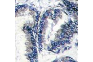 Formalin-fixed and paraffin-embedded human hepatocarcinoma reacted with DCAMKL1 Antibody (C-term) , which was peroxidase-conjugated to the secondary antibody, followed by DAB staining. (DCLK1 抗体  (C-Term))