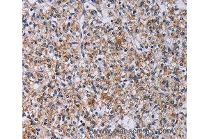 Immunohistochemistry of Human prostate cancer using CA4 Polyclonal Antibody at dilution of 1:30 (CA4 抗体)