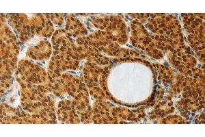 Immunohistochemistry of paraffin-embedded Human thyroid cancer using AKR1A1 Polyclonal Antibody at dilution of 1:30 (AKR1A1 抗体)