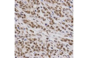 Immunohistochemistry of paraffin-embedded human gastric cancer using SMARCE1 Antibody.