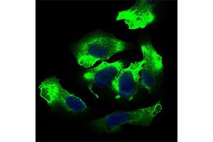 Immunohistochemical analysis of paraffin-embedded cervical cancer tissues using ALCAM antibody with DAB staining. (CD166 抗体  (AA 48-216))