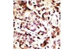 Formalin-fixed and paraffin-embedded human cancer tissue reacted with the primary antibody, which was peroxidase-conjugated to the secondary antibody, followed by DAB staining. (Beclin 1 抗体  (AA 181-210))