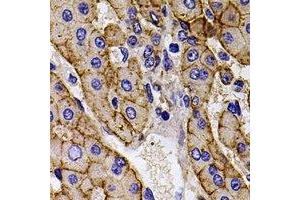 Immunohistochemical analysis of Calpain reg staining in human liver cancer formalin fixed paraffin embedded tissue section. (Calpain Reg 抗体)