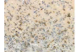 ABIN7093873 and ABIN7097916 at 1/100 staining human melanoma by IHC-P.