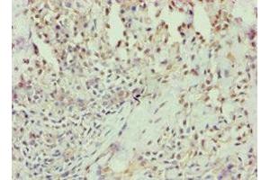 Immunohistochemistry of paraffin-embedded human breast cancer using ABIN7144294 at dilution of 1:100 (Annexin VII 抗体  (AA 259-488))