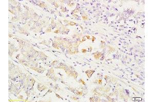 Formalin-fixed and paraffin embedded human gastric carcinoma labeled with Anti-MEK1/2(MAPKK1) Polyclonal Antibody, Unconjugated  at 1:200 followed by conjugation to the secondary antibody and DAB staining. (MEK1/2 抗体  (AA 301-393))