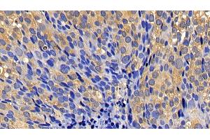 Detection of CASP1 in Human Breast cancer Tissue using Polyclonal Antibody to Caspase 1 (CASP1) (Caspase 1 抗体  (AA 317-404))
