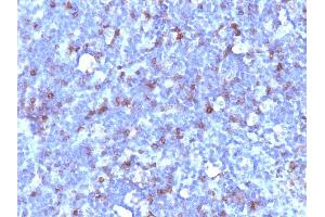 Formalin-fixed, paraffin-embedded human Lymphoma stained with CD43 Mouse Monoclonal Antibody (SPN/1094). (CD43 抗体)