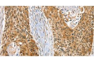 Immunohistochemistry of paraffin-embedded Human esophagus cancer using RAB27A Polyclonal Antibody at dilution of 1:30 (RAB27A 抗体)
