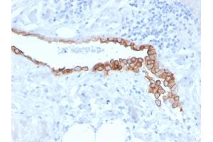 Formalin-fixed, paraffin-embedded human Lung Mesothelioma stained with Mesothelin Mouse Monoclonal Antibody (MSLN/3384). (Mesothelin 抗体  (AA 273-407))