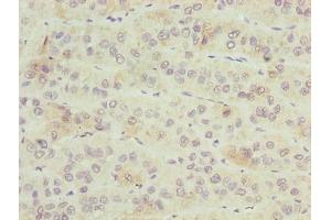 Immunohistochemistry of paraffin-embedded human liver cancer using ABIN7176441 at dilution of 1:100 (ZNF622 抗体  (AA 2-280))