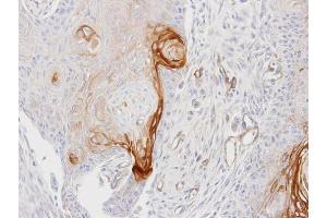 IHC-P Image Immunohistochemical analysis of paraffin-embedded Ca922 xenograft, using ENTPD6, antibody at 1:100 dilution.