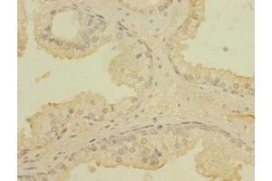 Immunohistochemistry of paraffin-embedded human prostata cancer using ABIN7171721 at dilution of 1:100 (CCDC79 抗体  (AA 301-550))