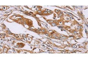 Immunohistochemistry of paraffin-embedded Human colon cancer using OS9 Polyclonal Antibody at dilution of 1:30 (OS9 抗体)