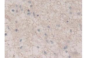Detection of UCRP in Human Glioma Tissue using Polyclonal Antibody to Ubiquitin Cross Reactive Protein (UCRP) (CLRN1 Antisense RNA 1 (CLRN1-AS1) (AA 2-157) 抗体)