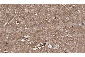 ABIN6279389 at 1/100 staining Human brain cancer tissue by IHC-P.