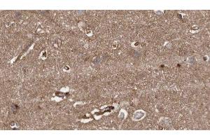 ABIN6279389 at 1/100 staining Human brain cancer tissue by IHC-P. (HACE1 抗体  (C-Term))