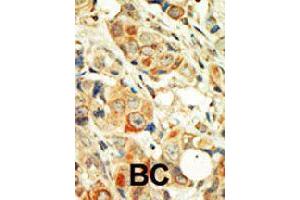 Formalin-fixed and paraffin-embedded human cancer tissue reacted with PRKCA polyclonal antibody  , which was peroxidase-conjugated to the secondary antibody, followed by DAB staining . (PKC alpha 抗体  (C-Term))