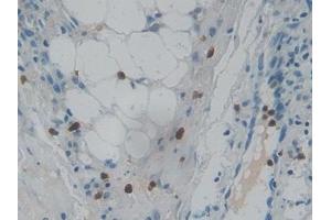 Detection of RNASE3 in Human Skin cancer Tissue using Polyclonal Antibody to Ribonuclease A3 (RNASE3) (RNASE3 抗体  (AA 30-154))