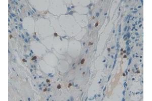 Detection of RNASE3 in Human Skin cancer Tissue using Polyclonal Antibody to Ribonuclease A3 (RNASE3) (RNASE3 抗体  (AA 30-154))