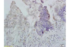 Formalin-fixed and paraffin embedded human rectal carcinoma labeled with Rabbit Anti APOA2 Polyclonal Antibody, Unconjugated (ABIN708686) at 1:200 followed by conjugation to the secondary antibody and DAB staining (APOA2 抗体  (AA 24-100))