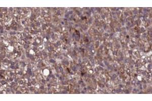 ABIN6276824 at 1/100 staining Human liver cancer tissue by IHC-P. (KIR2DL3 抗体)