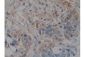 DAB staining on IHC-P; Samples: Human Pancreatic cancer Tissue (NME4 抗体  (AA 67-185))