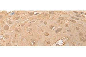 Immunohistochemistry of paraffin-embedded Human esophagus cancer tissue using CPNE3 Polyclonal Antibody at dilution of 1:40(x200) (Copine III 抗体)