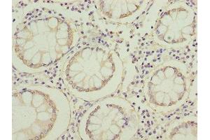Immunohistochemistry of paraffin-embedded human colon cancer using ABIN7152640 at dilution of 1:100 (FABP1 抗体  (AA 1-127))