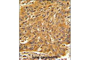 Formalin-fixed and paraffin-embedded human lung carcinoma with Fascin Antibody , which was peroxidase-conjugated to the secondary antibody, followed by DAB staining. (Fascin 抗体  (AA 322-350))
