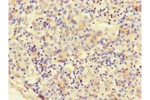 Immunohistochemistry of paraffin-embedded human lung cancer using ABIN7160331 at dilution of 1:100 (FAT Atypical Cadherin 2 (FAT2) (AA 123-314) 抗体)