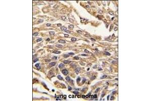 Formalin-fixed and paraffin-embedded human lung carcinoma tissue reacted with ARSB antibody (C-term) (ABIN391670 and ABIN2841581) , which was peroxidase-conjugated to the secondary antibody, followed by DAB staining. (Arylsulfatase B 抗体  (C-Term))