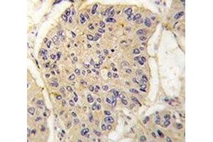 IHC analysis of FFPE human lung carcinoma tissue stained with FKBP12 antibody (FKBP1A 抗体  (AA 43-74))