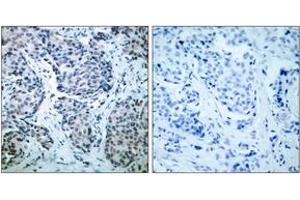 Immunohistochemistry analysis of paraffin-embedded human breast carcinoma, using SEK1/MKK4 (Phospho-Thr261) Antibody. (MAP2K4 抗体  (pThr261))