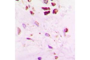 Immunohistochemical analysis of SENP5 staining in human lung cancer formalin fixed paraffin embedded tissue section. (SENP5 抗体  (C-Term))