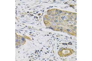 Immunohistochemistry of paraffin-embedded human lung cancer using KRT20 Antibody (ABIN5970078) at dilution of 1/100 (40x lens). (KRT20 抗体)