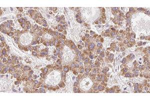 ABIN6279308 at 1/100 staining Human liver cancer tissue by IHC-P. (Claudin 23 抗体  (Internal Region))