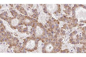 ABIN6279308 at 1/100 staining Human liver cancer tissue by IHC-P.