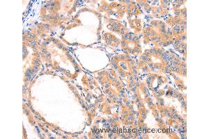 Immunohistochemistry of Human thyroid cancer using PRDX2 Polyclonal Antibody at dilution of 1:80 (Peroxiredoxin 2 抗体)