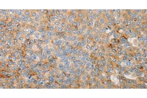 Immunohistochemistry of paraffin-embedded Human liver cancer using IGFBP1 Polyclonal Antibody at dilution of 1:30 (IGFBPI 抗体)