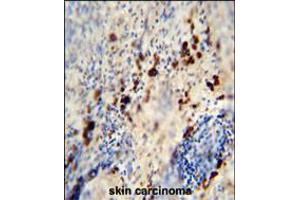 LCE1A antibody immunohistochemistry analysis in formalin fixed and paraffin embedded human skin carcinoma followed by peroxidase conjugation of the secondary antibody and DAB staining. (LCE1A 抗体  (C-Term))